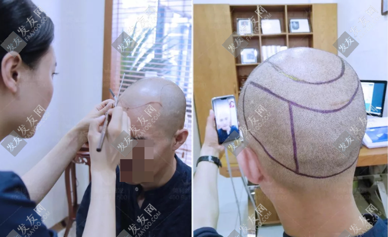 德州植發醫院哪家好？醫院排名及科普植發多少錢